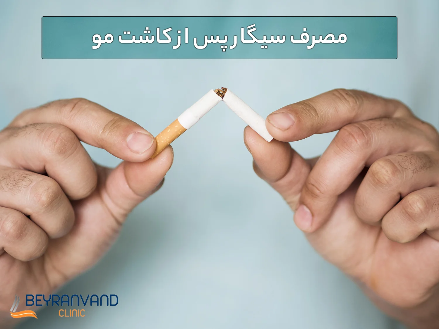 مصرف سیگار پس از کاشت مو